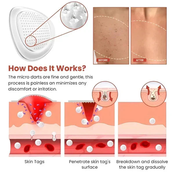 Derma Smooth Skin Tag Removal Patch